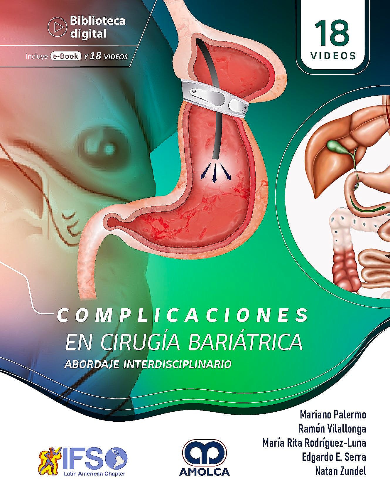 Complicaciones en Cirugía Bariátrica. Abordaje Interdisciplinario