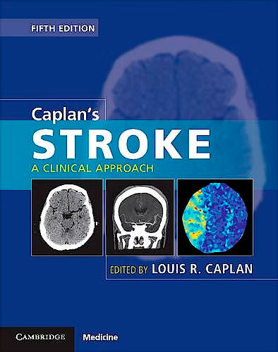 Caplan's Stroke. A Clinical Approach