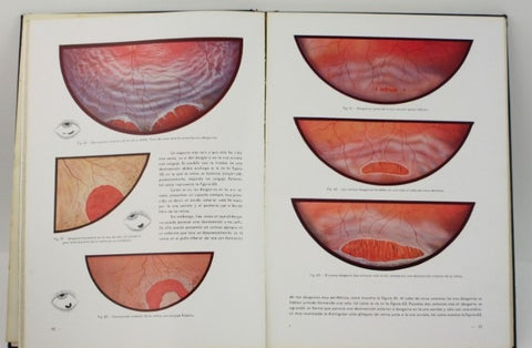 El desprendimiento de la retina - Facsímil