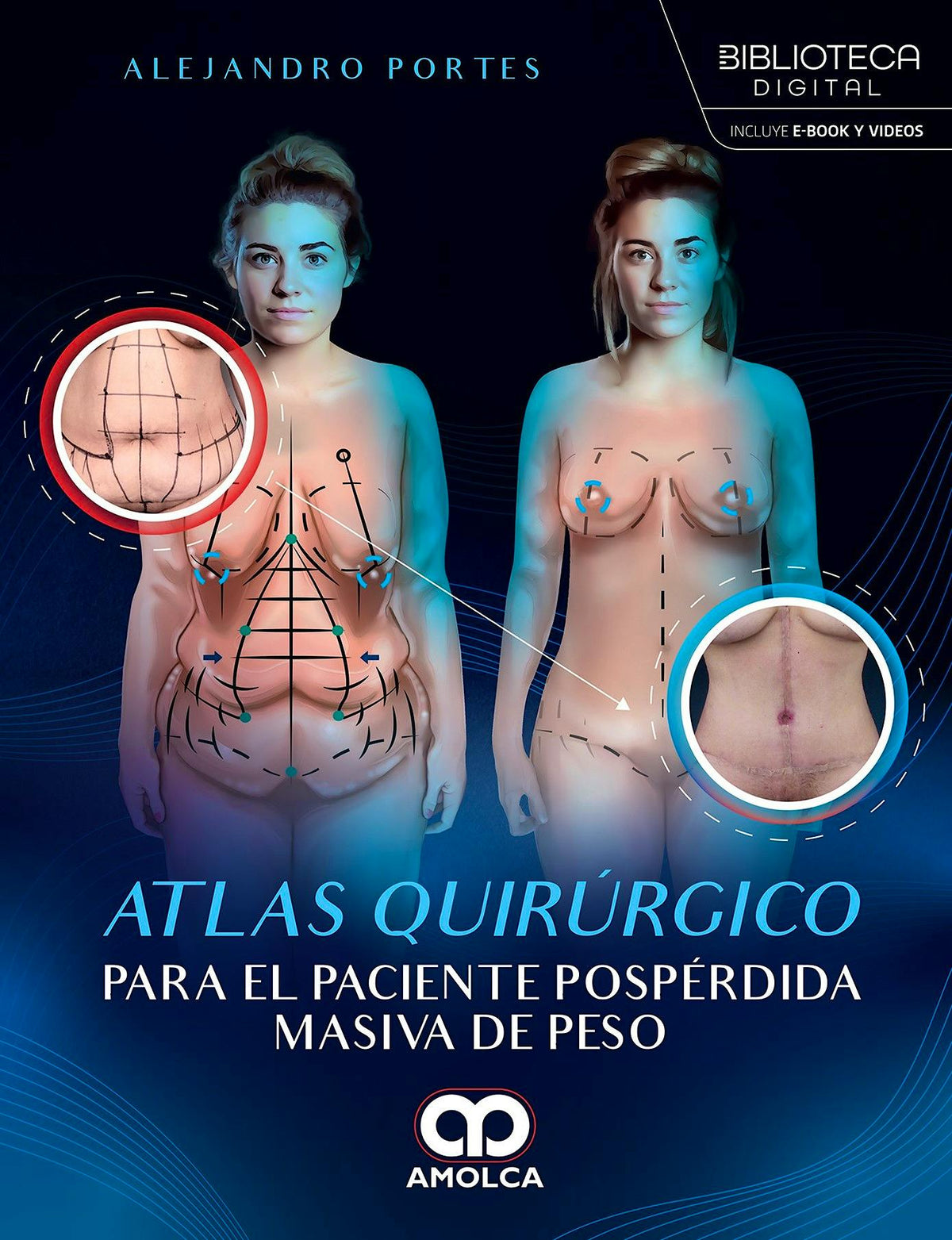 Atlas Quirúrgico para el Paciente Pospérdida Masiva de Peso