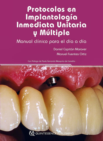 Protocolos en Implantología Inmediata Unitaria y Múltiple. Manual Clínico para el Día a Día