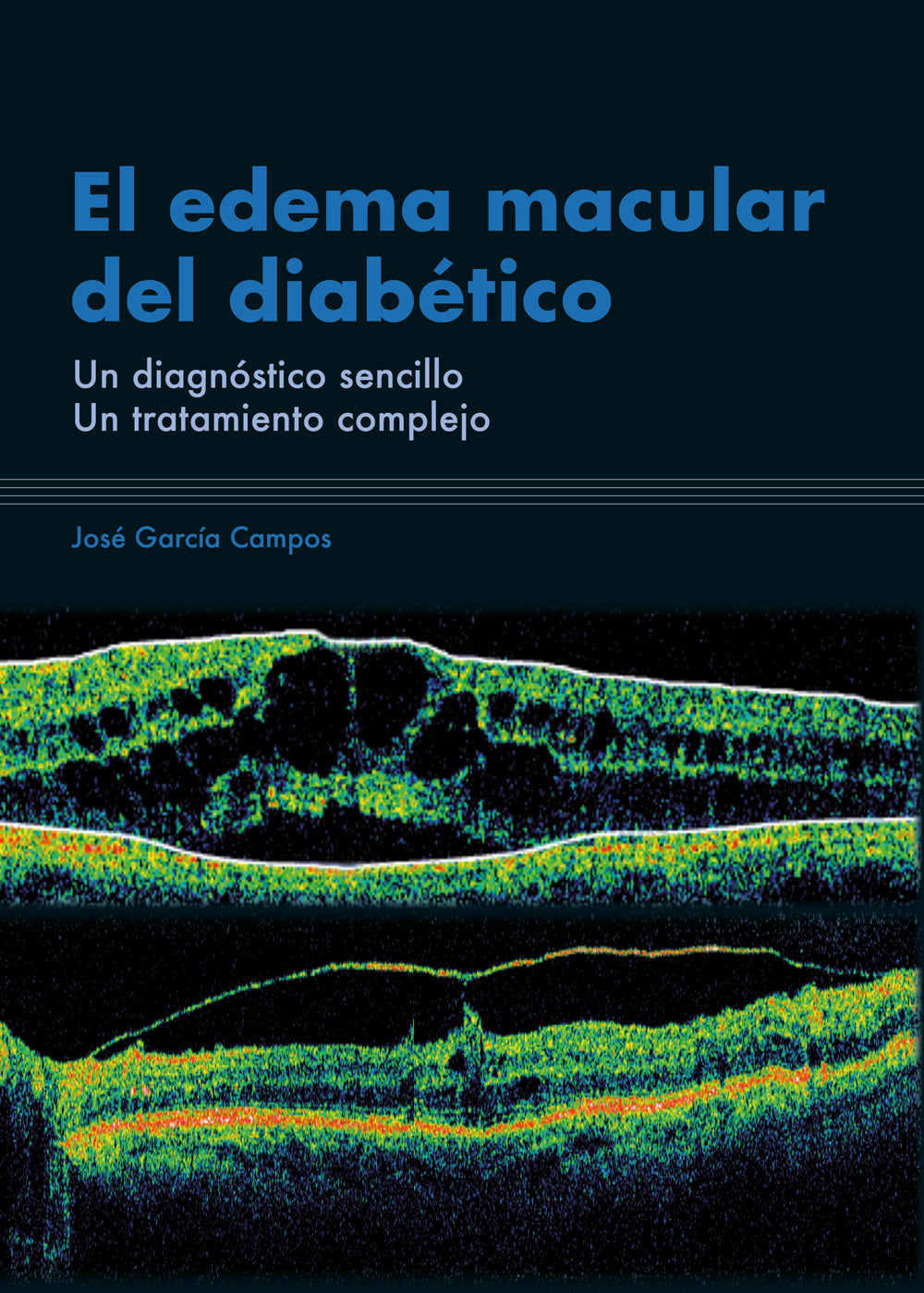 El edema macular del diabético