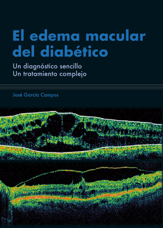 El edema macular del diabético
