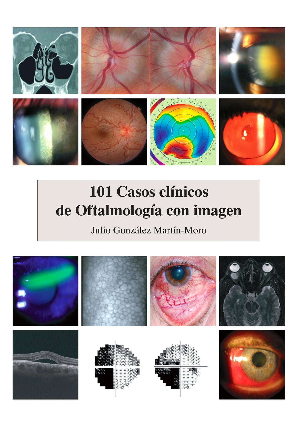 101 Casos Clínicos de Oftalmología con Imagen