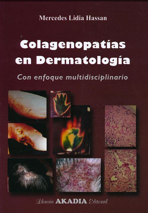 Colagenopatías en Dermatología con Enfoque Multidisciplinario