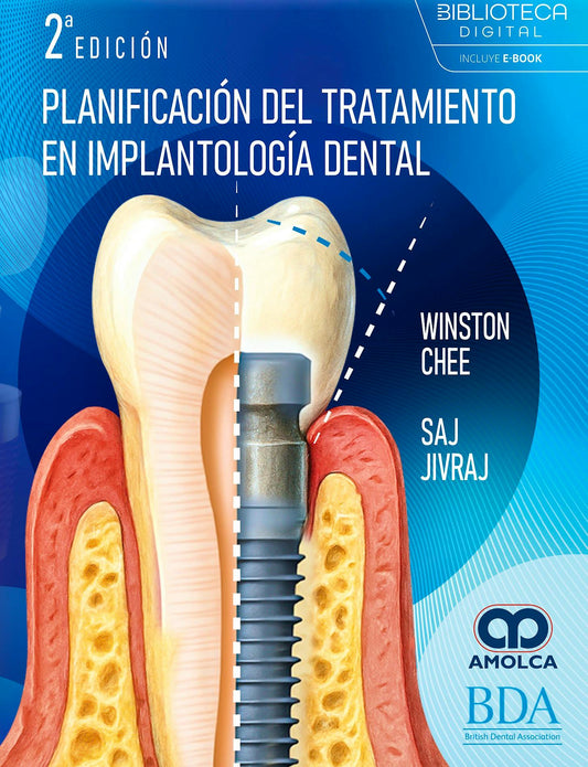 Planificación del Tratamiento en Implantología Dental