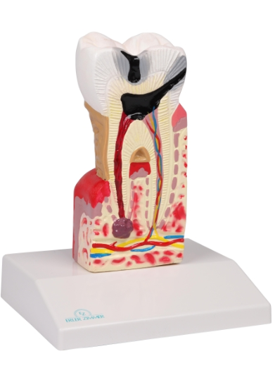 Modelo Dental de Caries  10 veces su tamaño natural - D214