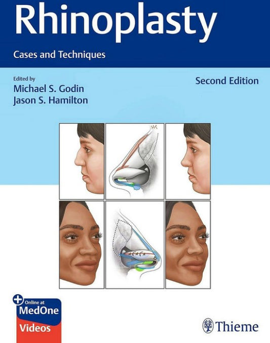 Rhinoplasty. Cases and Techniques