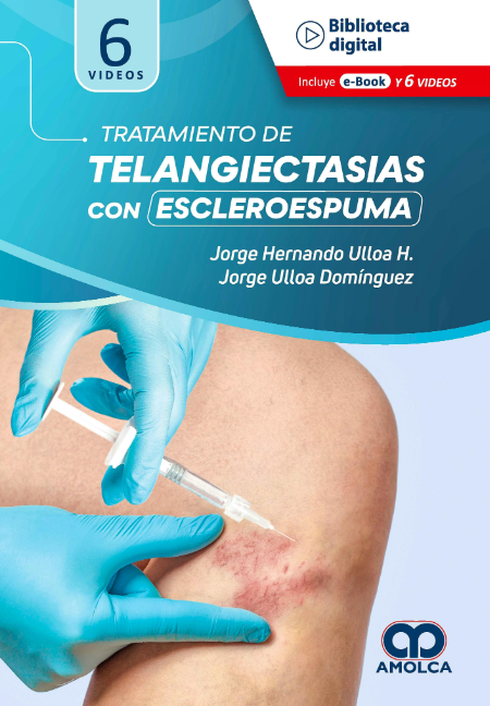 Tratamiento de Telangiectasias con Escleroespuma