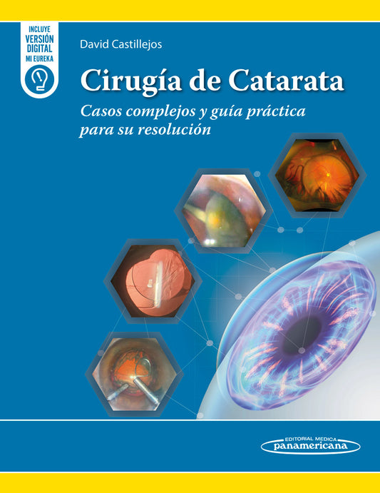 Cirugía de Catarata. Casos complejos y guía práctica para su resolución