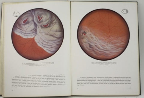 El desprendimiento de la retina - Facsímil