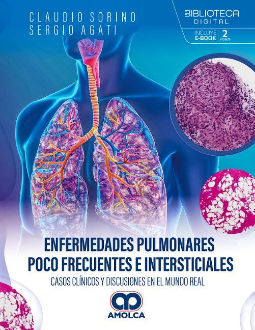 Enfermedades Pulmonares Poco Frecuentes e Intersticiales