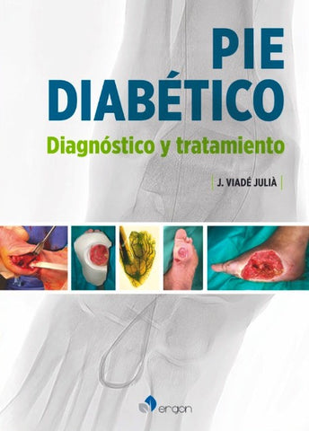 Pie Diabético. Diagnóstico y Tratamiento