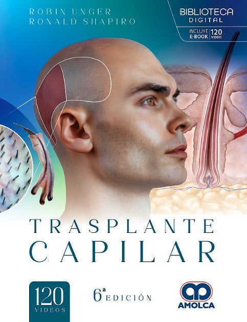 Trasplante Capilar