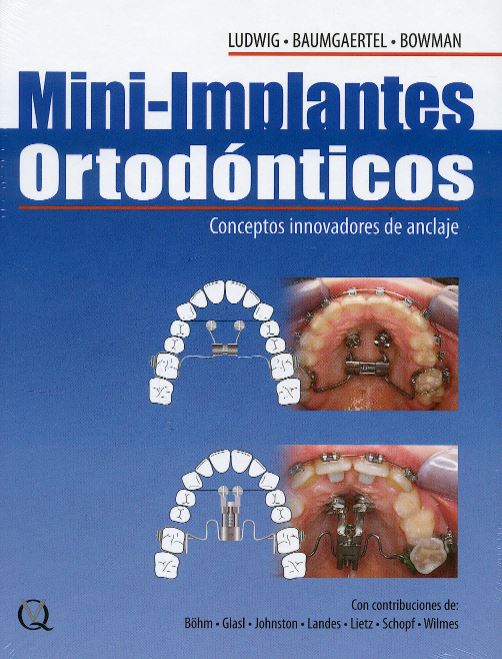 Mini-Implantes Ortodónticos