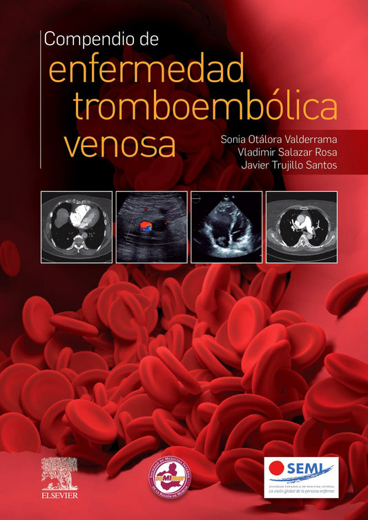 Compendio de Enfermedad Tromboembólica Venosa