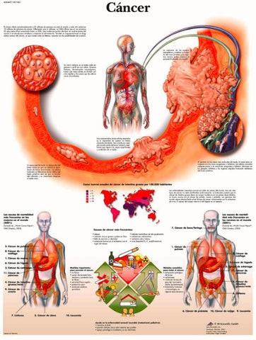 Lámina CÁNCER DE COLON