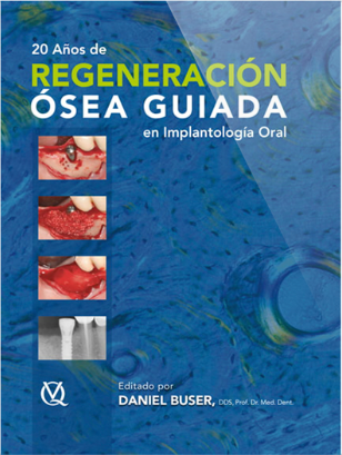 20 años de Regeneración ósea Guiada en Implantología Oral