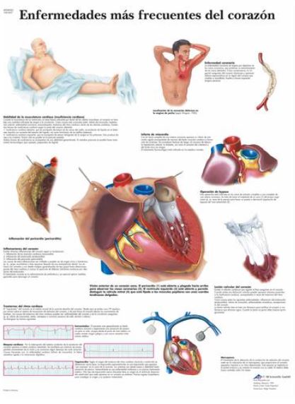 Lámina ENFERMEDADES MÁS FRECUENTES DEL CORAZÓN