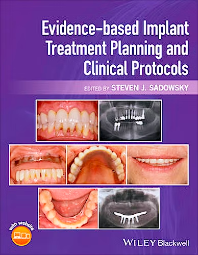 Evidence- based Implant Treatment Planning and Clinical Protocols
