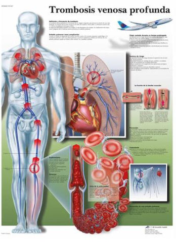 Lámina TROMBOSIS VENOSA PROFUNDA