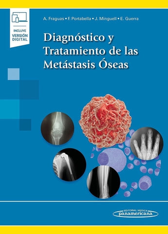 Diagnóstico y Tratamiento de las Metástasis Óseas ISBN: 9788491107804 Marban Libros